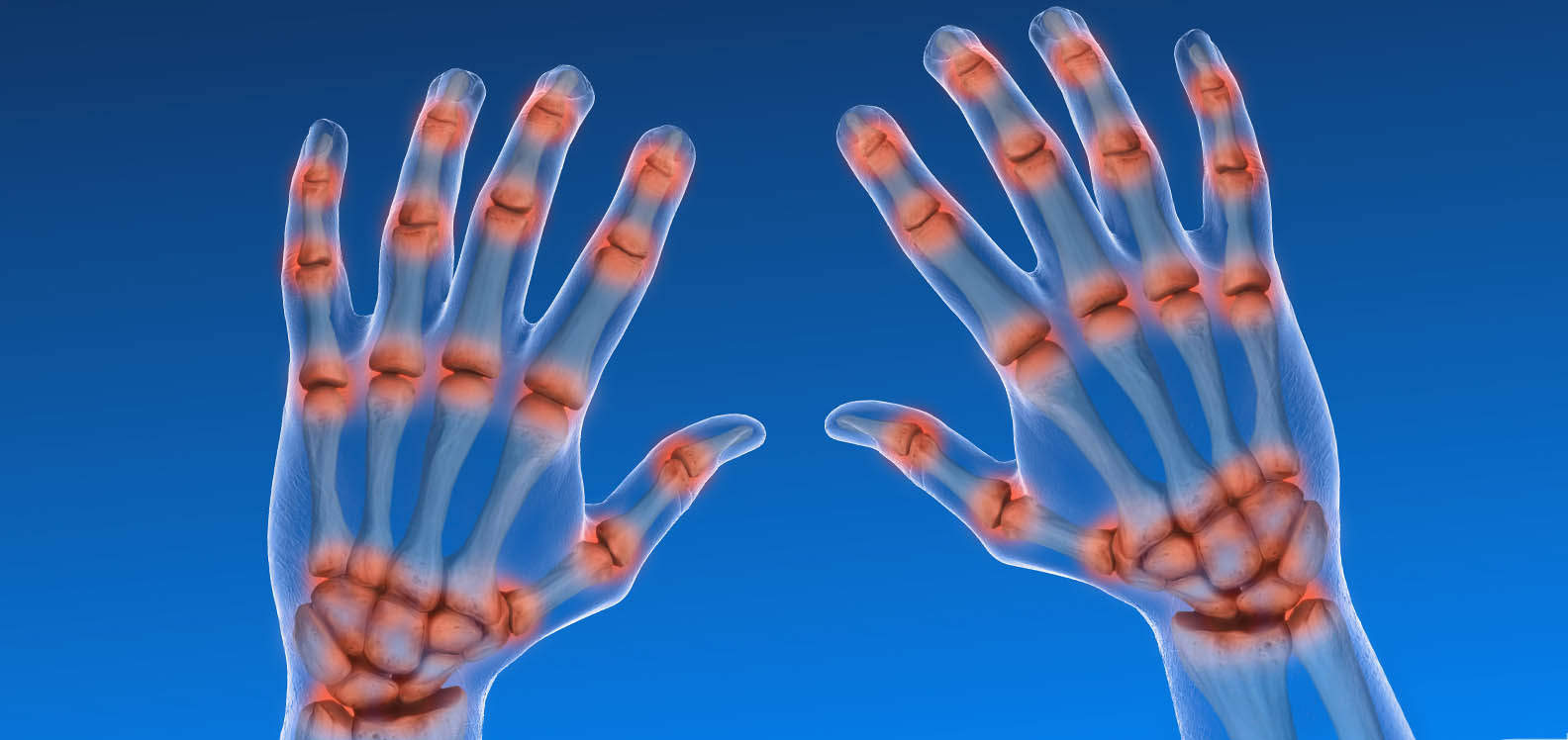 Pelydr-X o ddwylo sy'n goleuo lle mae arthritis gwynegol yn achosi poen yn goch.